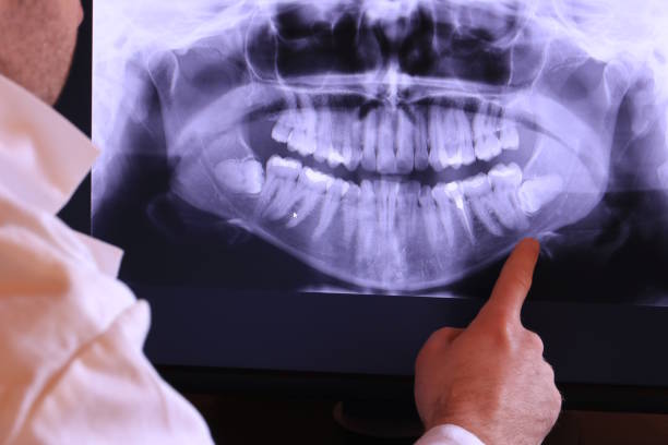 Best Emergency Wisdom Teeth Removal in Penn Farms, PA